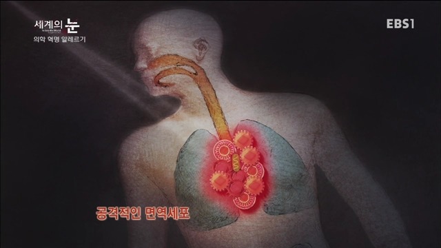 다큐 세계의 눈 - 의학 혁명 알레르기 | 인스티즈